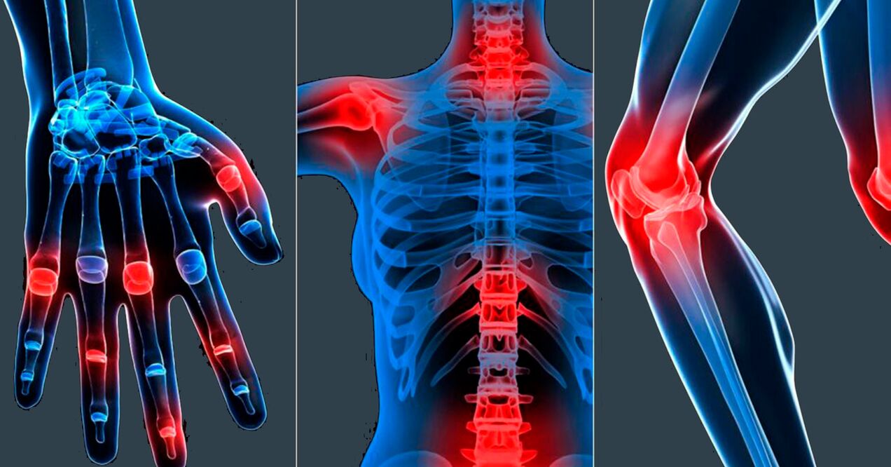 Indikácie pre použitie extraktu Boswellia v kapsulách